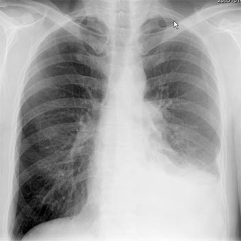 x rays of lung cancer. X-Ray.jpg